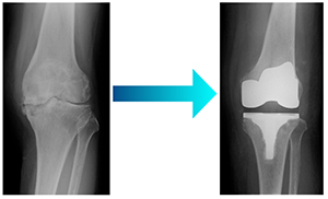 図１ 全人工膝関節置換術
