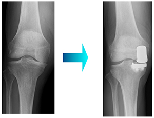 図２ 単顆人工膝関節置換術